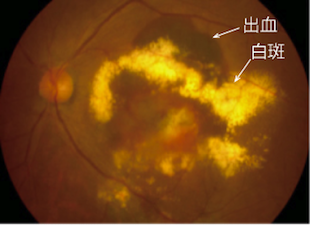 滲出型加齢黄斑変性症の眼底写真 (黄斑部に出血や白斑を認めます)