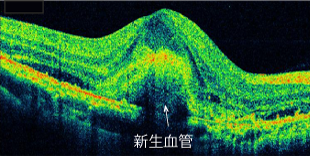 滲出型加齢黄斑変性症の黄斑部OCT画像 (黄斑部網膜の下新生血管の塊を認めます)