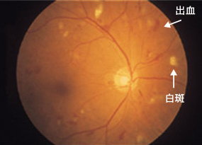 増殖前糖尿病網膜症の眼底写真