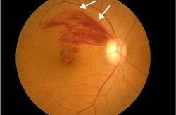 網膜静脈分枝閉塞症の眼底写真