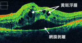 網膜静脈閉塞症による黄斑浮腫の黄斑部OCT画像