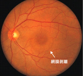 中心性漿液性脈絡網膜症の眼底写真