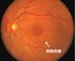 中心性漿液性脈絡網膜症の眼底写真