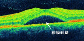 中心性漿液性脈絡網膜症の黄斑部OCT画像