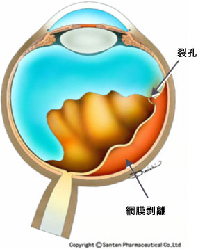裂孔原性網膜剥離の模式図