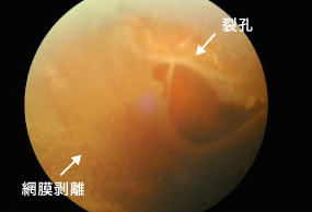 裂孔原性網膜剥離の眼底写真(裂孔から網膜剥離を生じています)