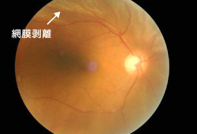 裂孔原性網膜剥離の眼底写真(同じ方の後極部写真で上方網膜から黄斑部に近づく網膜剥離を認めます)