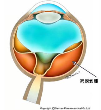 牽引性網膜剥離の模式図