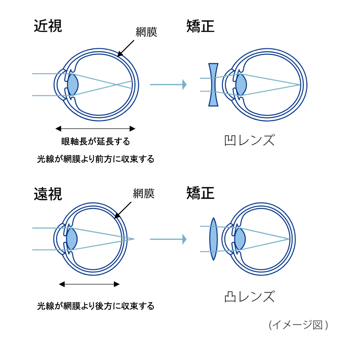 小児の近視について｜たまプラーザ南口眼科